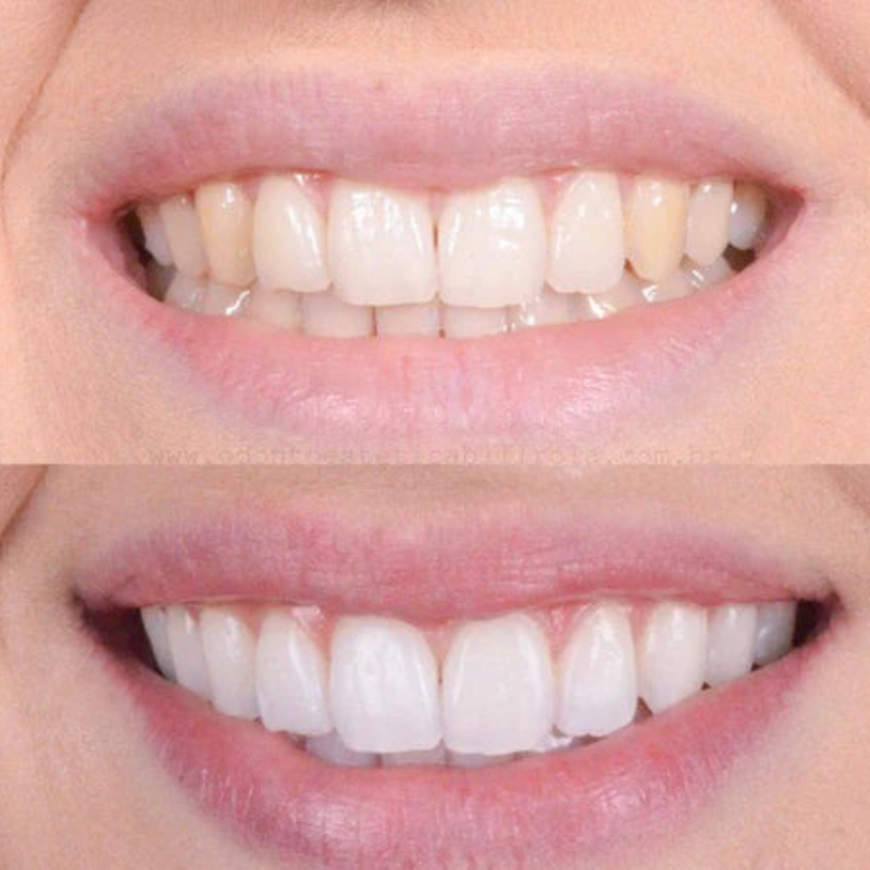 SmileShine™ – Professionelle Zahnreinigung für zu Hause