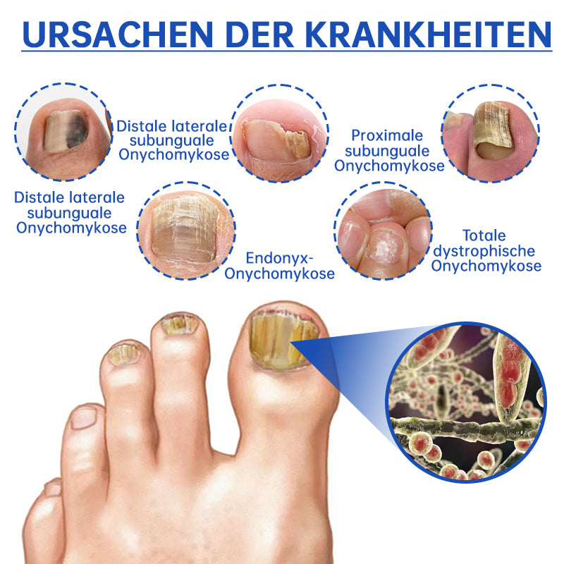 NailCure™ – Der sanfte Laser gegen Nagelpilz!