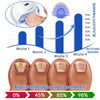 NailCure™ – Der sanfte Laser gegen Nagelpilz!