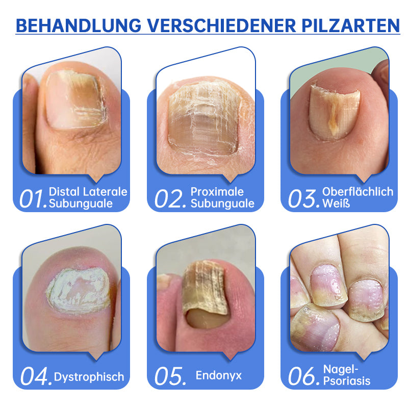 NailCure™ – Der sanfte Laser gegen Nagelpilz!